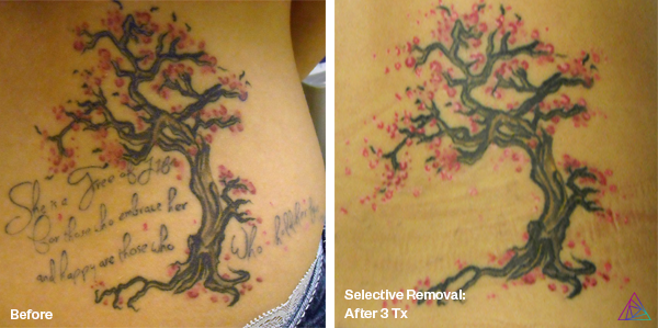 Before and after tattoo removal